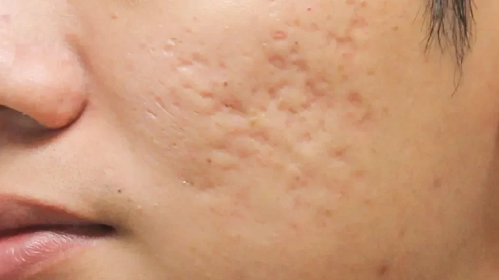 Rolling and Boxcar Scars Explained