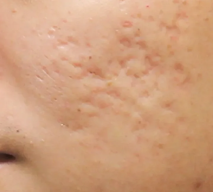 Rolling and Boxcar Scars Explained